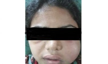सिम्स में 38 वर्षीय महिला के रेडिकुलर सिस्ट का सफल उपचार