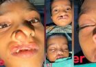 चिरायु योजना से जन्मजात समस्या से मिली राहत, तीन बच्चों के चेहरों पर लौटी मुस्कान
